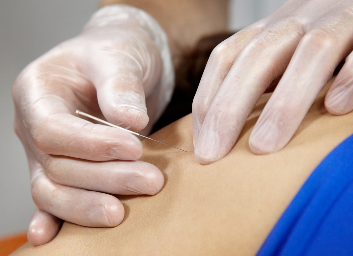 Dry Needling – What Is It And How Can It Help?